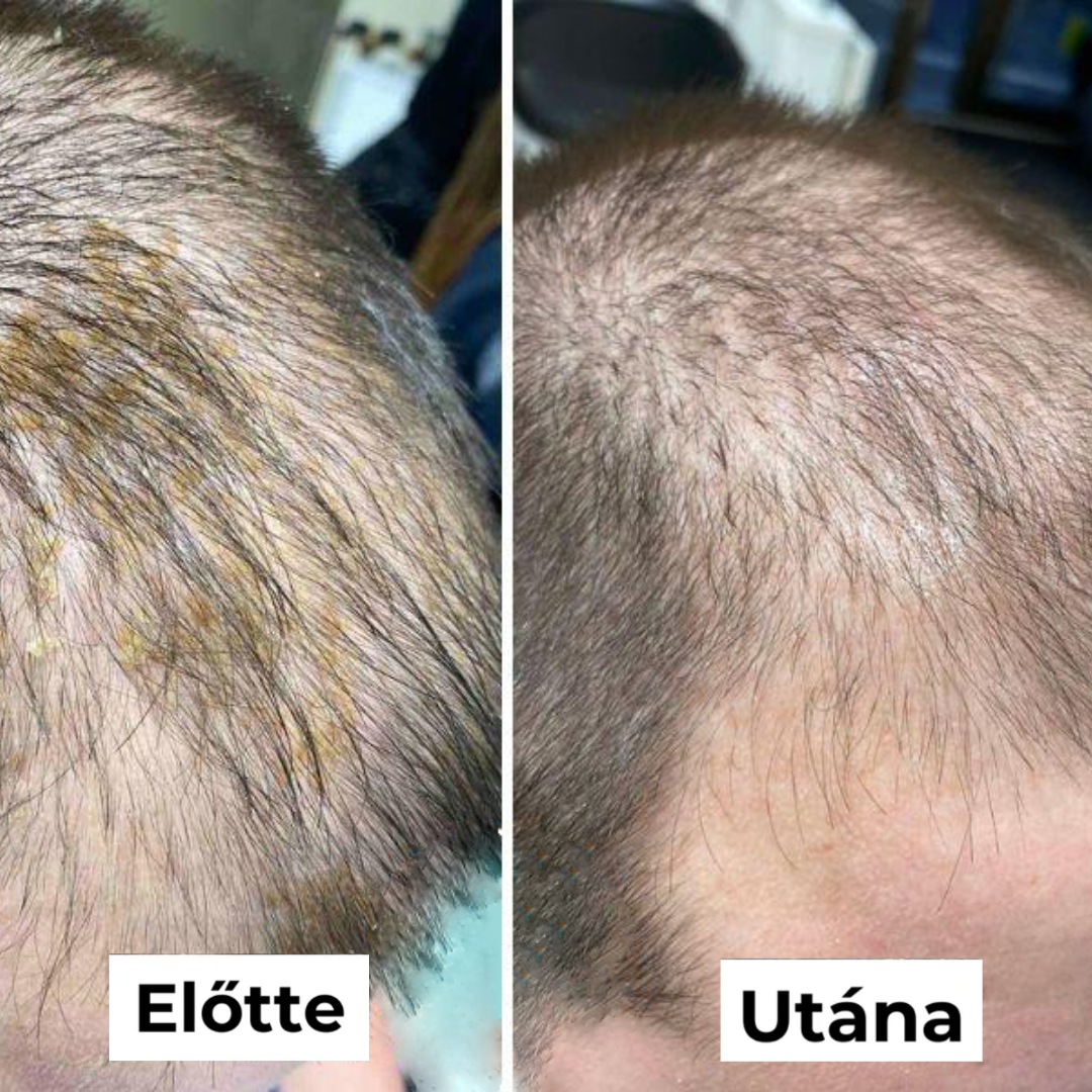 Savbázisú Fejbőrtisztító Férfiaknak