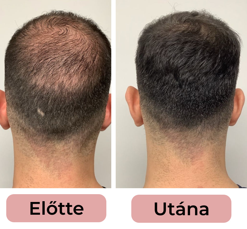8 Hetes Hajnövekedést Serkentő Kúra